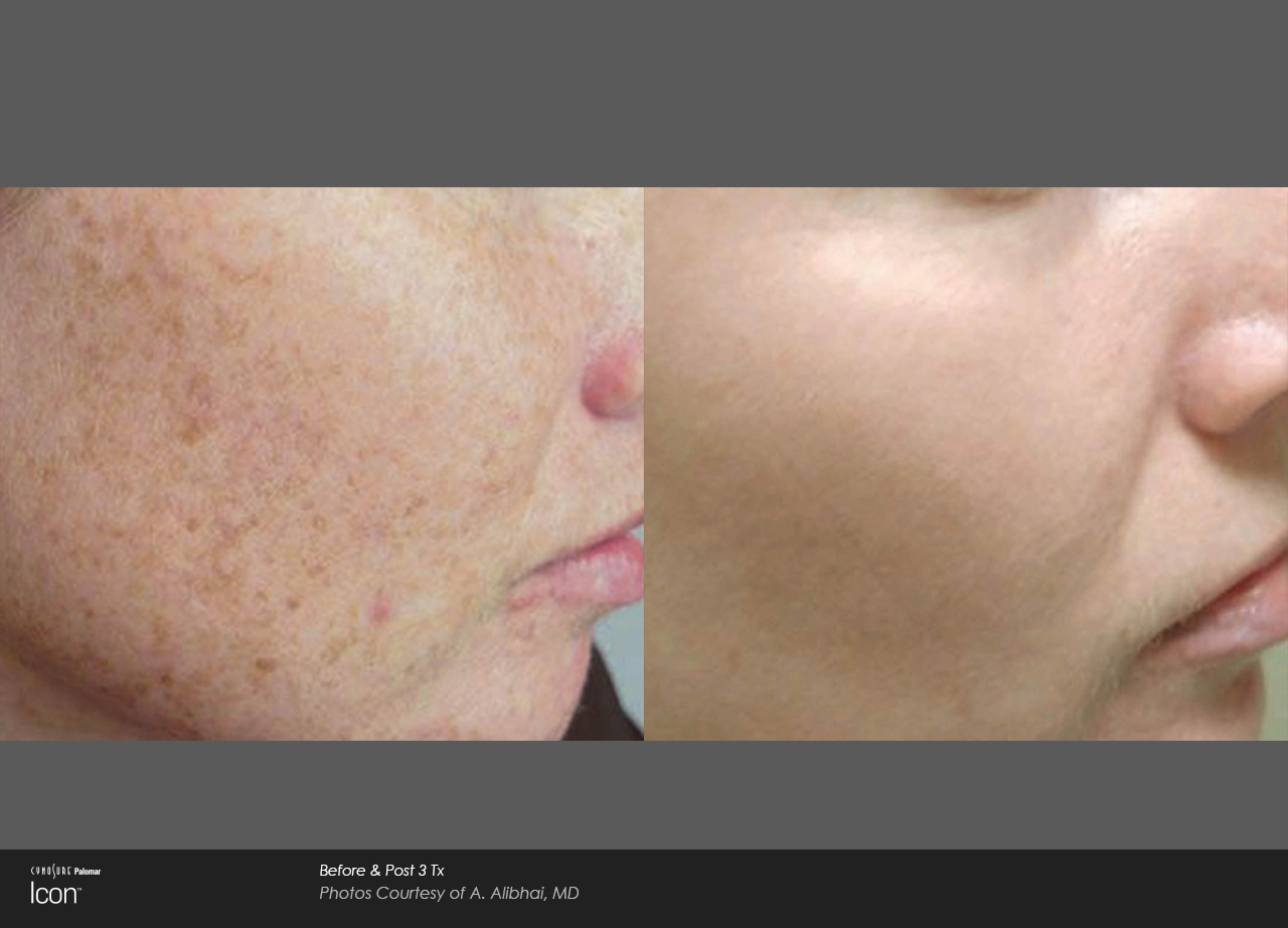 ICON Before and After | Sunshine Med Spa