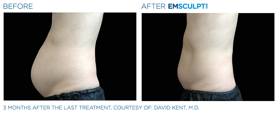 EMSCULPT NEO Before and After | Sunshine Med Spa